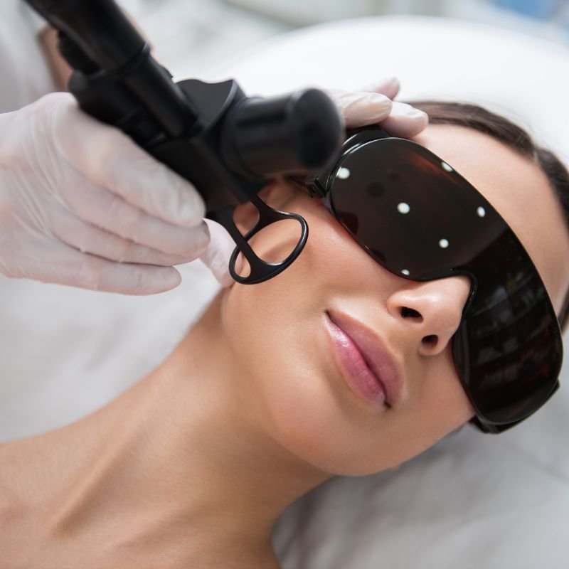 c02 laser facial
