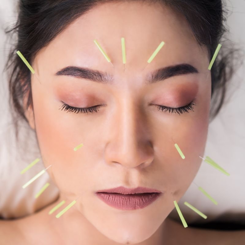 facial acupuncture